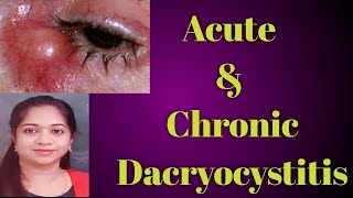 Dacryocystitis  Acute dacryocystitis Chronic Dacryocystitis Stages of Dcryocystitis Mucocele [upl. by Noseyt]