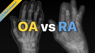 Osteoarthritis OA vs Rheumatoid Arthritis RA Explained  XRay Examples [upl. by Catto]