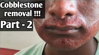 How to cure cobblestones cobblestone removal part 2  tamil [upl. by Llet]