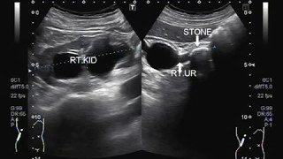 Ultrasound Video showing a large stone in ureter near PUJ [upl. by Odarnoc]