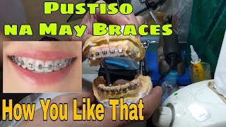 Pustiso with Retainer Like Braces How You Like That Pustiso with Braces Denture with braces [upl. by Blodget]