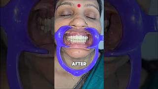 Smile transformation teeth healthyteeth youtubeshorts zirconiumcrowns viralshort magic crown [upl. by Eednarb]