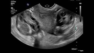 Bilateral salpingitis ultrasound [upl. by Nilhtac927]