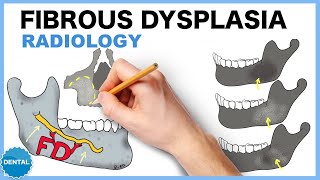 Fibrous dysplasia Radiology [upl. by Anitan]