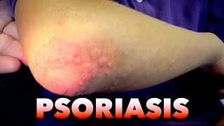 PSORIASIS RASH New Diagnosis  Dr Paul [upl. by Ahseim]