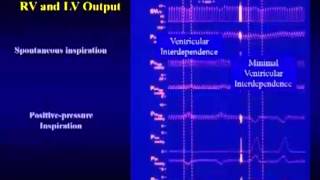 AMMCTI Monitoreo hemodinámico funcional determinando respuesta al volumen [upl. by Aisayn]