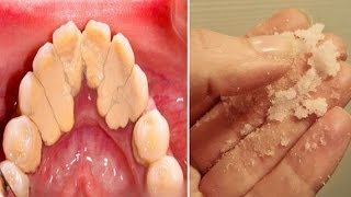 How to Get Rid of Plaque  Home Remedies for Plaque and Tartar [upl. by Assena]