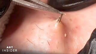 How Ingrown Hairs Are Removed  Art Insider [upl. by Rosette970]