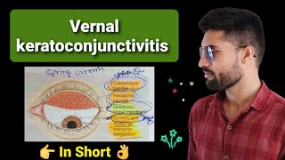 vernal keratoconjunctivitis  Spring catarrh lecture opthalmology [upl. by Elok]