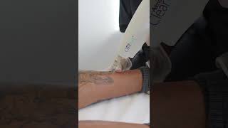 Nathan Henry Laser Tattoo Removal with Este Medical [upl. by Rebekkah]