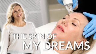 This treatment CHANGED my skin Microneedling amp radiofrequencythe latest technology for skin [upl. by Umont]