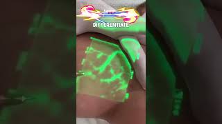 VeinViewer Visualizing Vein Location [upl. by Harolda]