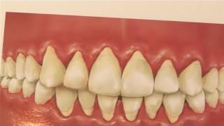 How To Treat Receding Gums [upl. by Daigle]