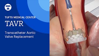 TAVR Transcatheter Aortic Valve Replacement  Tufts Medical Center [upl. by Elum129]