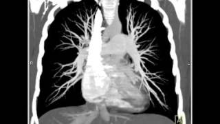 Lung Anatomy Pulmonary Embolism MIP [upl. by Leirua106]