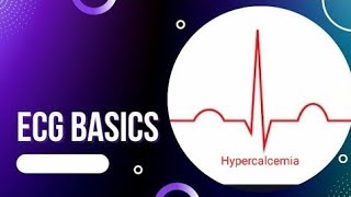 ECG Basics  ECG Changes in Hypercalcemia  Causes of Hypercalcemia [upl. by Jeffcott]