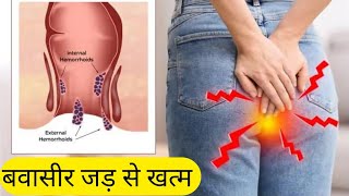 Hemorrhoids अंग्रेजी Medicine से बवासीर अब जड़ से समाप्त Piles Treatment By Allopathic Medicine [upl. by Astri]