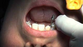 Perform the Ultimate Atraumatic Extractin with the Easy X Trac System [upl. by Greg]