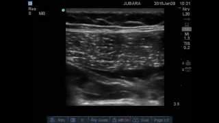 sciatic nerve block parasacral approach [upl. by Nannoc]