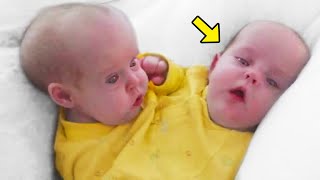 Remember These Conjoined Twins Separated 18 Years Ago This Is What Happened To Them [upl. by Ettenauq710]