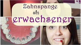 Zahnspange bei erwachsenen  Lingualtechnik  Kosten  JuMarie [upl. by Aisinut697]