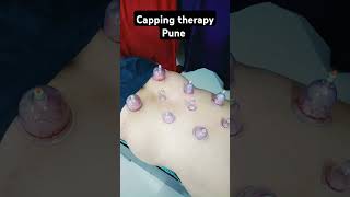 Aman Cupping Therapy back pain relief Capping therapy therapy [upl. by Yerocal424]