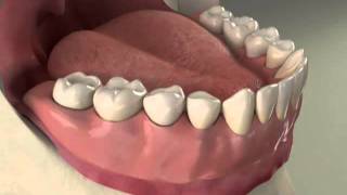 Implants Overdenture Lower Procedure [upl. by Dolan]