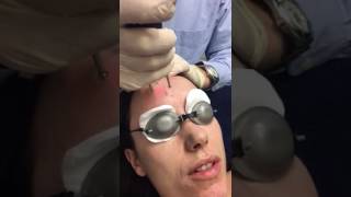 Erbium Yag Laser Treatment using Asclepion MCL31 Dermablate [upl. by Willie]