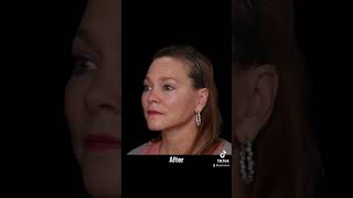 Facelift Surgery Before amp After  Facial Plastic Surgeon Dr Robert Glasgold [upl. by Anahcra338]