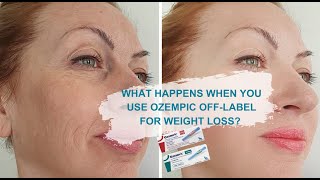 Ozempic Reviews Ozempic WeightLoss Before and After  How Safe Is It [upl. by Kursh]