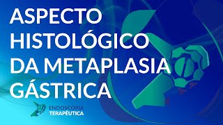 Aspecto histológico da metaplasia gástrica [upl. by Krik302]