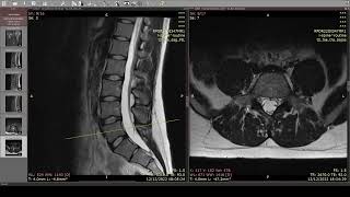 Interpretando la Resonancia Magnética Lumbar a un suscriptor [upl. by Lladnew]