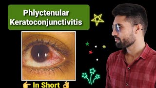 Phlyctenular keratoconjunctivitis lecture opthalmology [upl. by Enneirb]