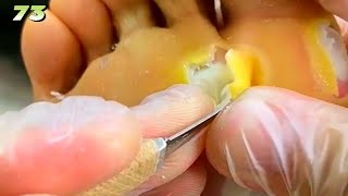 73Clean up large lesions on the soles of the feet [upl. by Arabela743]