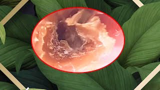 Satisfying Ear Wax Removal With Dr Zhao Video [upl. by Kristen]