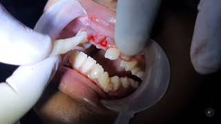 Reimplantation of Avulsed Tooth [upl. by Ahsened]