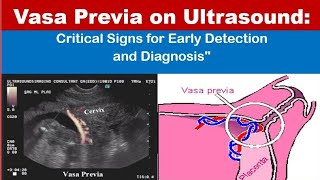 Vasa previa on Ultrasound [upl. by Yhprum830]