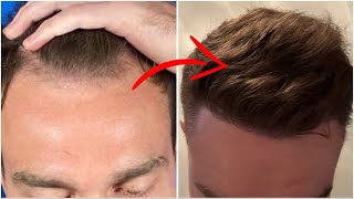 My 8month Second Hair Transplant Results [upl. by Nivlac94]