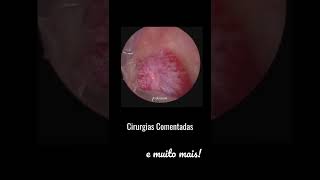 Pólipo cervical histeroscopia histeroscopiacirurgica [upl. by Ardyth]