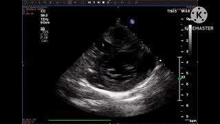 Mal alignment VSD with severe PS [upl. by Alrzc]