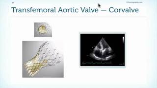 Assessment of Prostheses in Echocardiography [upl. by Ardelis464]