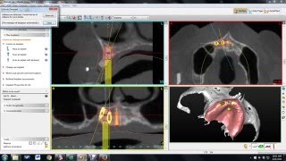 Simplant treatment planning [upl. by Darnell]