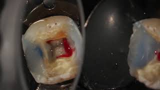 Complete endodontic treatment of a lower first molar step by step [upl. by Olimreh]