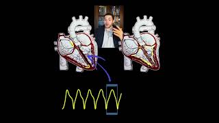 The meaning of a wide QRS complex Shorts [upl. by Tallbot]