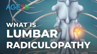 What Is Lumbar Radiculopathy  Lumbar Nerve Roots  Disc Bulge [upl. by Aretahs]