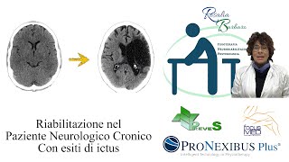 Ipertono e spasticità post ictus quali approcci o terapie Dressa Ft Barbaro Rosalia [upl. by Ikaz]