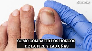 Cómo eliminar los hongos de LA PIEL Y LAS UÑAS [upl. by Merras]