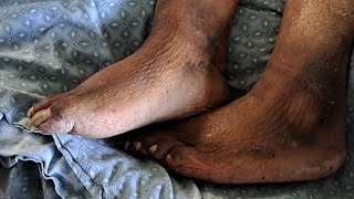 EXTREMELY CURVY TOENAILS PEDICURE FROM NURSING HOME IN BEDAMAZING RESULTS [upl. by Eeram]