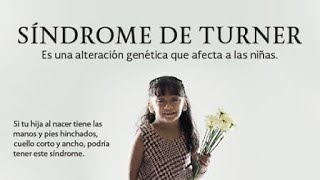 El Sindrome de Turnersindrome q afecta Ninas [upl. by Tannen865]