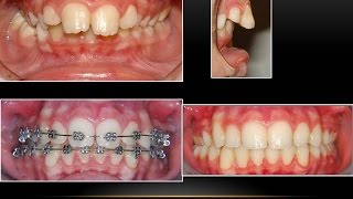 SevEre Crowding with Deep Bite Orthodontist [upl. by Atinna]